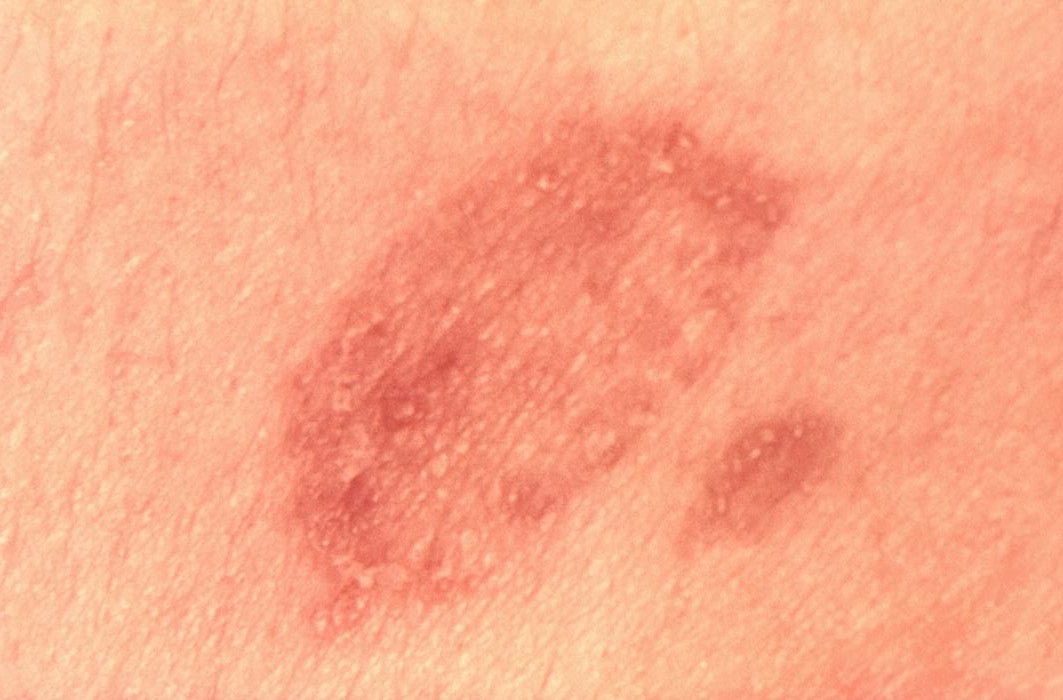 Ringworm: Picture, causes, symptoms and treatment