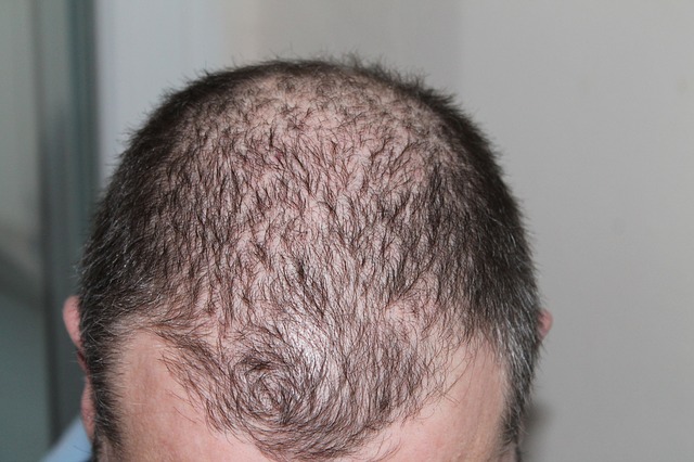 Psoriasis and Hair Loss: What's the Connection? - Medical ...