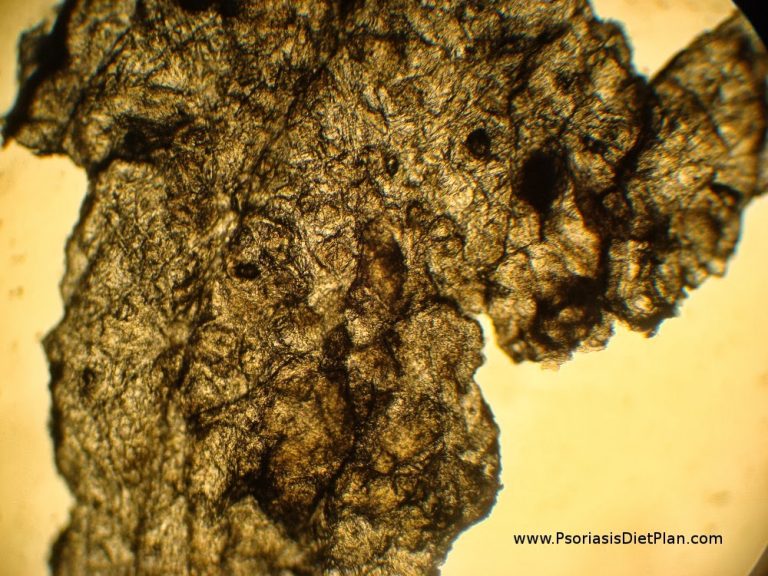 Psoriasis Plaque Under Microscope