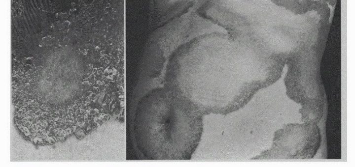 Psoriasis improved on cholestyramine