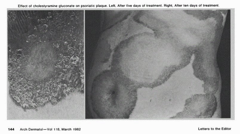 Psoriasis improved on cholestyramine