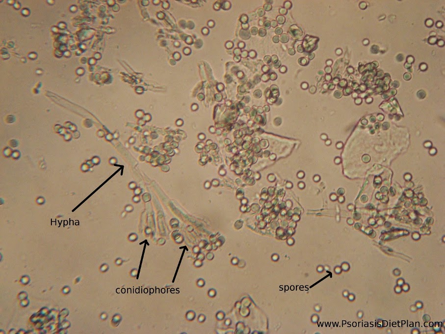 Eye floaters or fungal infection?