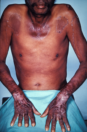 In pellagra both sides of the body are affected - arms, hands, legs and even the area under the neck. In that case the rash is also referred to as "collar".