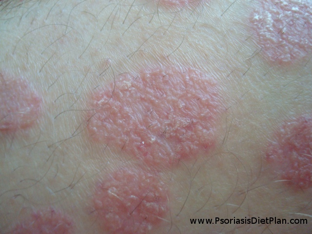 Broken off hair in the psoriasis plaque are caused by fungal infection. You can see also from one hair follicle there growing 2 hairs which also may be caused by fungal infection in my opinion.