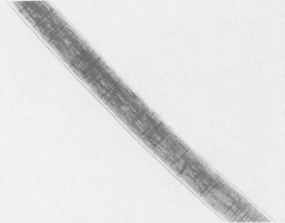 Those dark lines are actually a fungal tunnels as the fungus grows through the hair shaft.