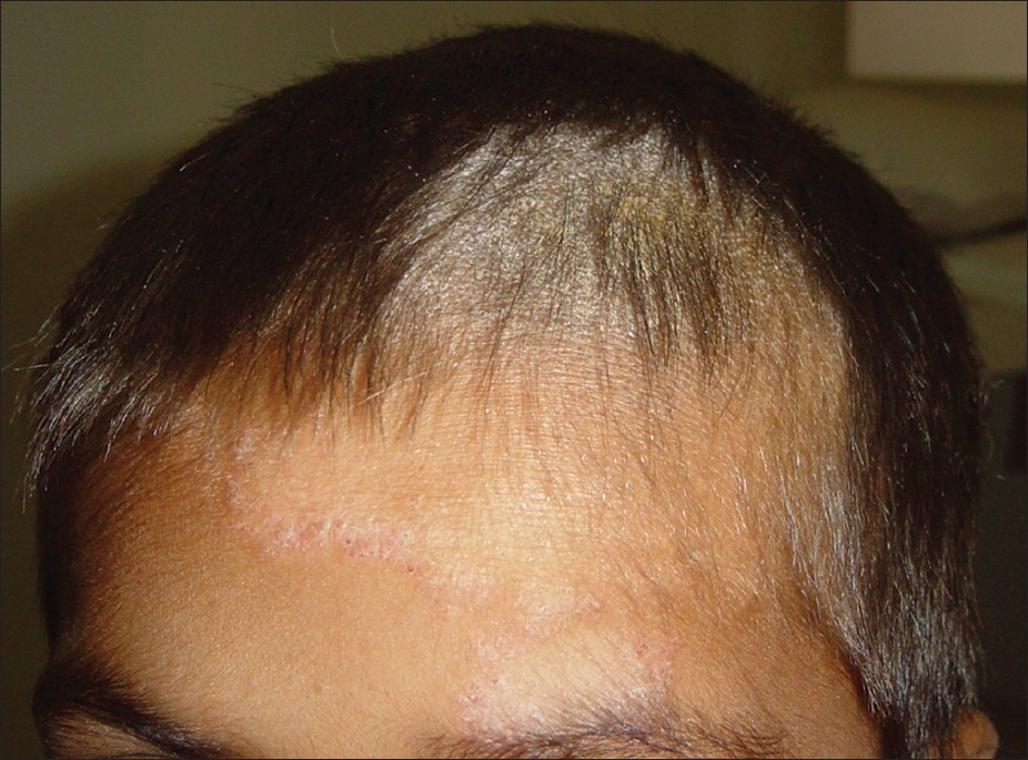 ringworm causes psoriasis and it is contagious