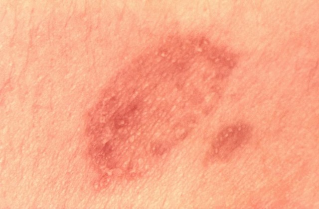 Ringworm Causes Psoriasis and It Is Contagious ... Ringworm Causes Psoriasis and It Is Contagious ...