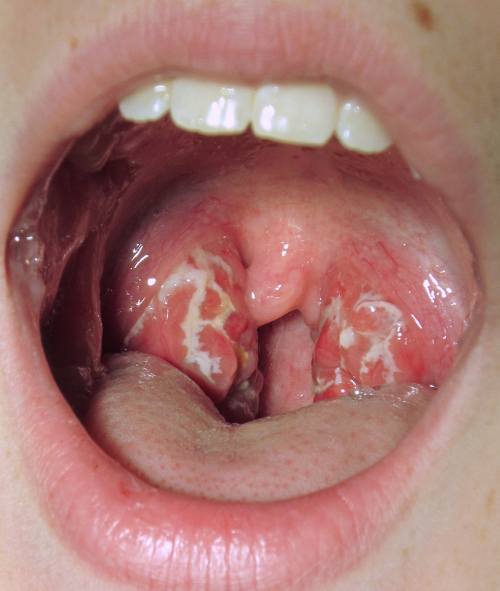 strep_throat