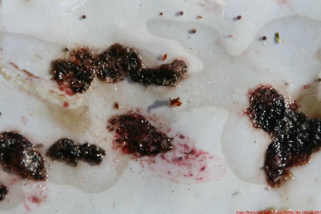 Spoiled and melted fake gallstones - liver flush vs. psoriasis
