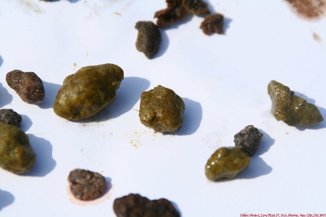 Fake gallstones - liver flush vs. psoriasis